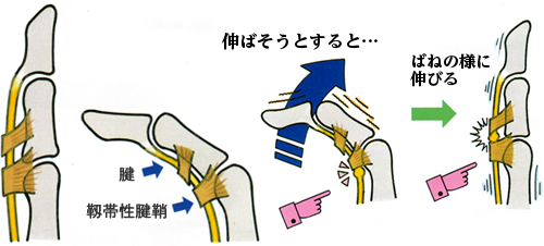 東御市,上田市,小諸市,整体,指圧,ほぐしや,ばね指改善方法