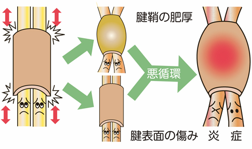東御市,上田市,小諸市,整体,指圧,ほぐしや,ばね指改善方法